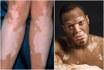 البهاق Vitiligo: أنواعه و علاجه